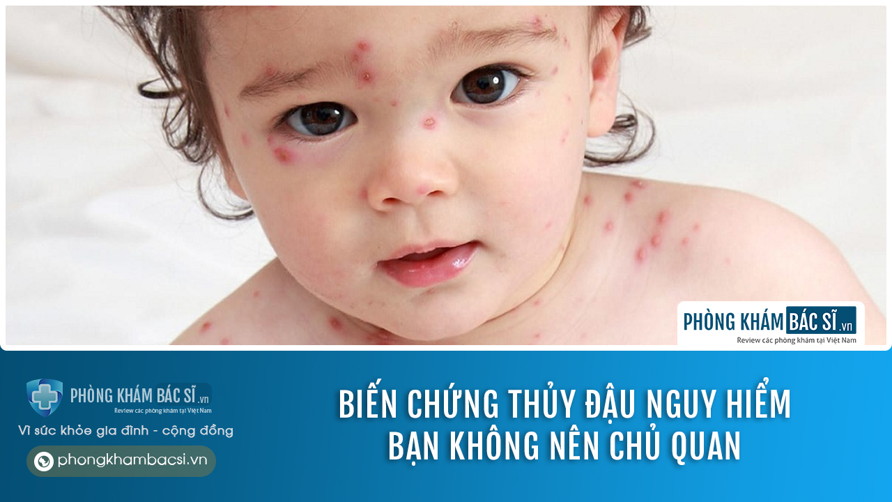 Thủy đậu ở trẻ: Chuẩn đoán & Phương pháp chữa trị tốt nhất