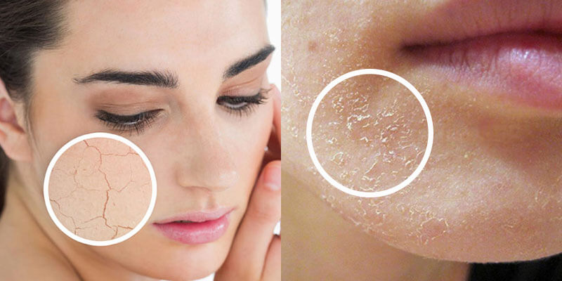 Da khô nứt nẻ: Nguyên nhân và Cách chữa trị