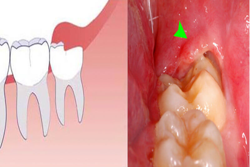 Chữa trị mọc răng khôn