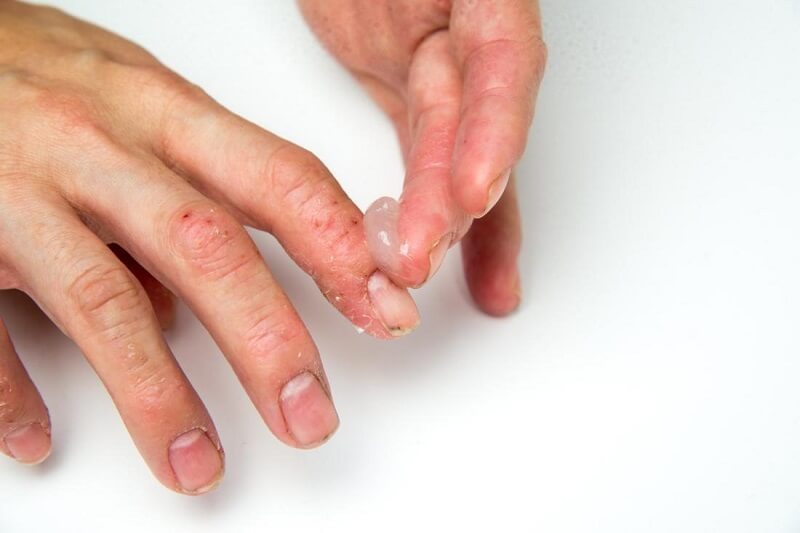 Bệnh vảy nến móng tay