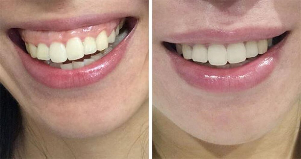 Bệnh cười hở lợi