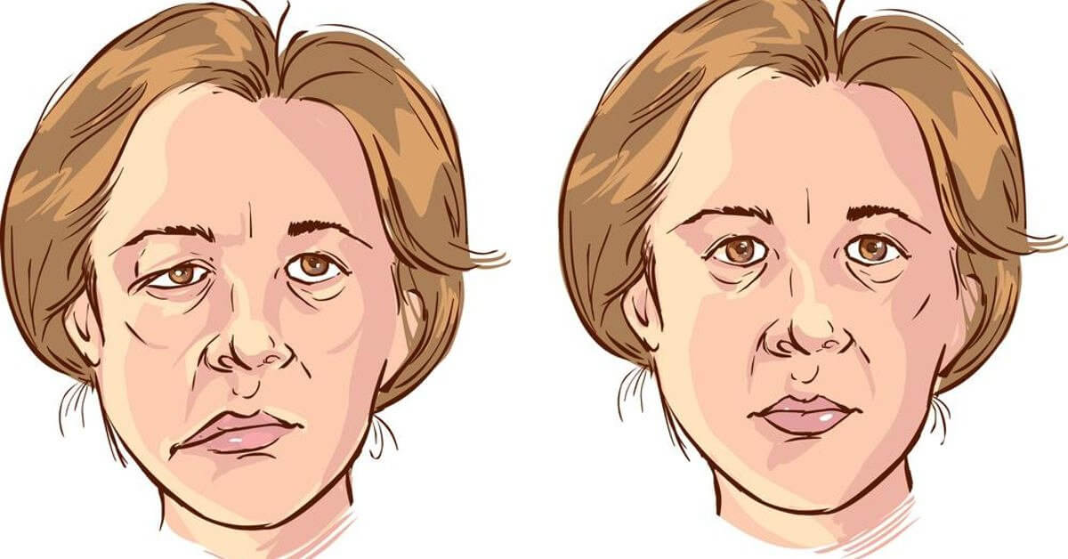 Liệt dây thần kinh số 7 có nguy hiểm không? Nguyên nhân, dấu hiệu và cách chữa trị