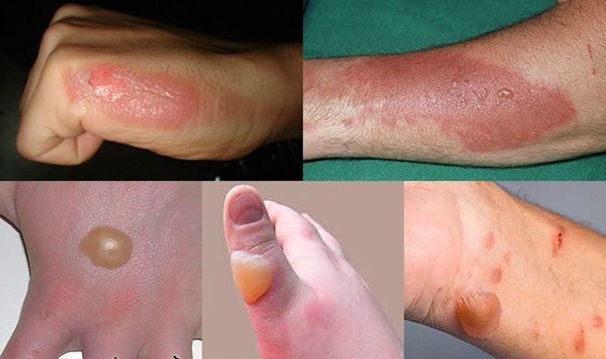 Sẹo bỏng: Nguyên nhân & Cách điều trị