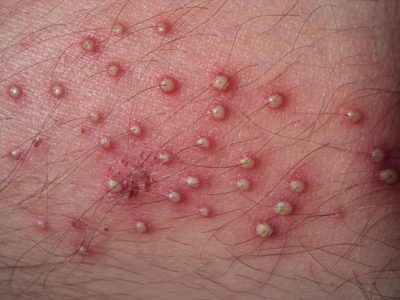 Mức độ nguy hiểm của viêm nang lông