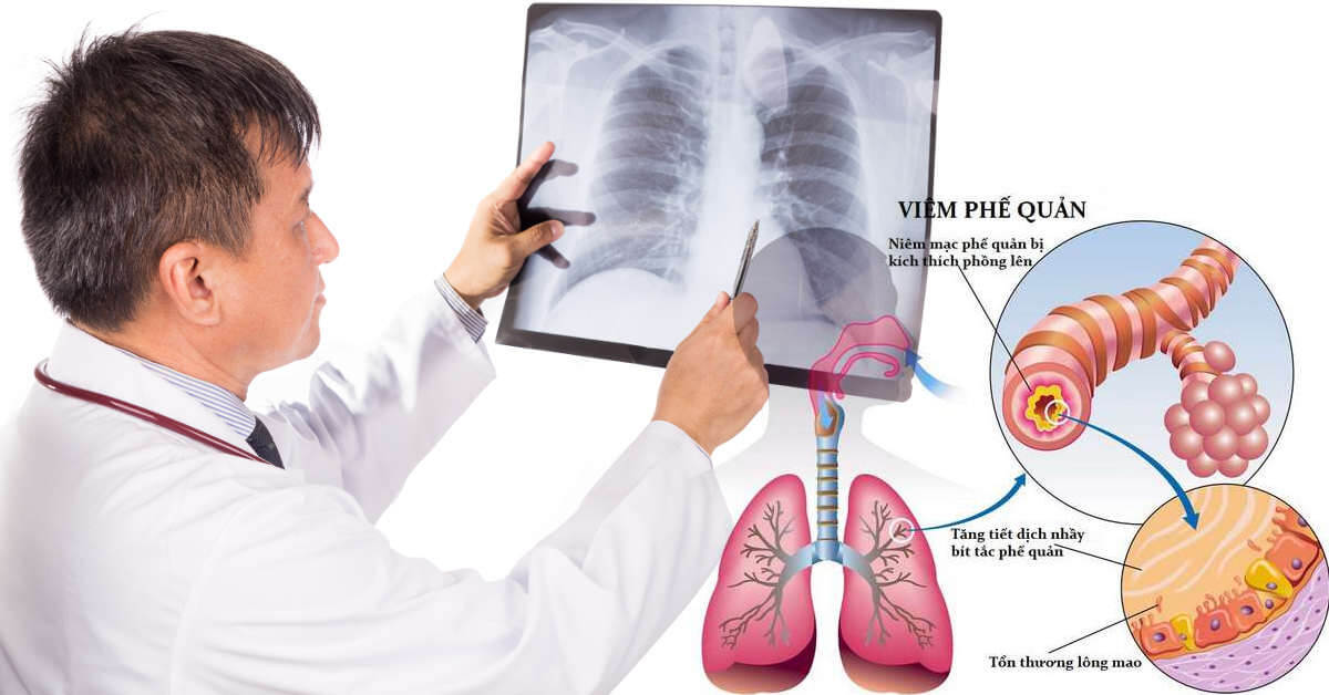 Bệnh viêm phế quản