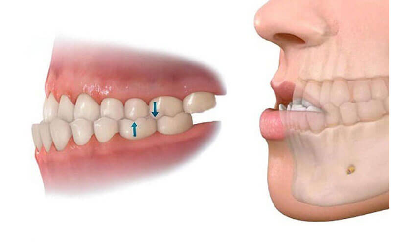 Dấu hiệu nhận biết Cắn ngược? Nguyên nhân và phương pháp chữa trị