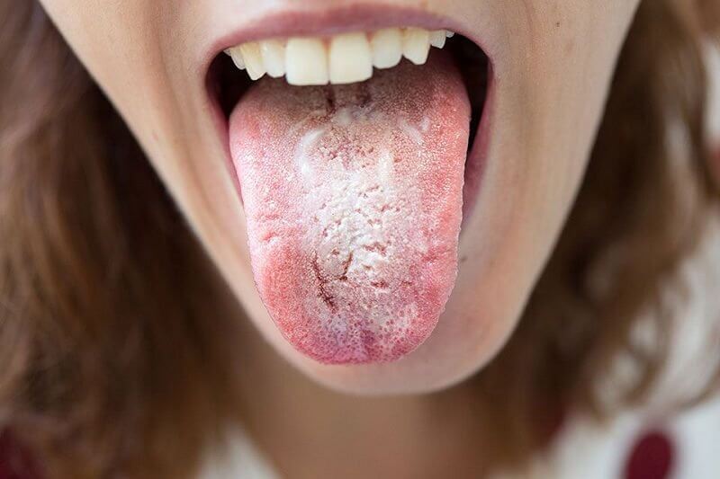 Bệnh Candida
