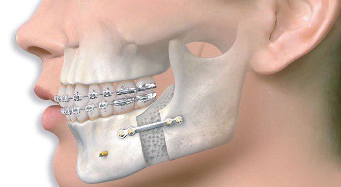 Gãy xương hàm: Nguyên nhân & Cách điều trị