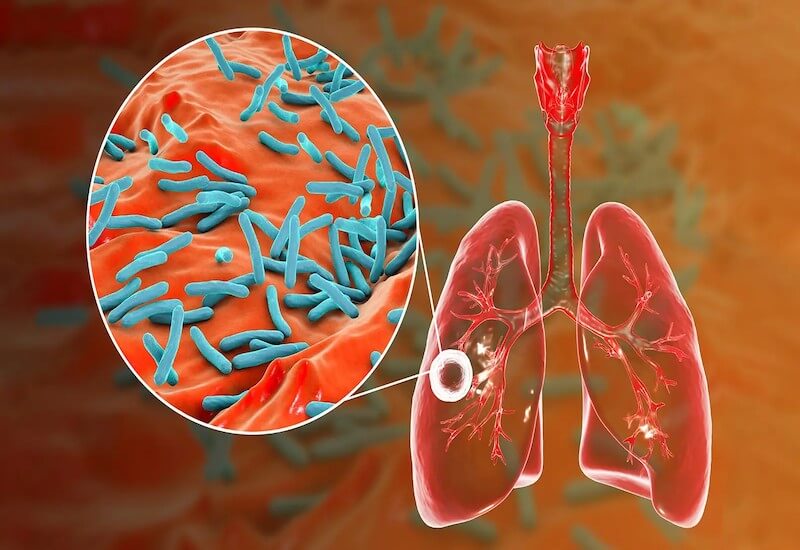 Lao có lây không? Triệu chứng và cách chữa trị