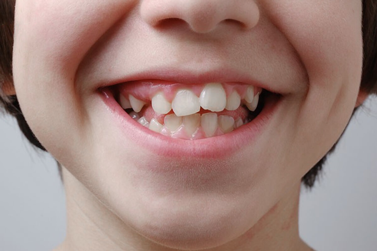 Lệch khớp cắn là gì? Nguyên nhân và cách khắc phục Lệch khớp cắn an toàn và hiệu quả