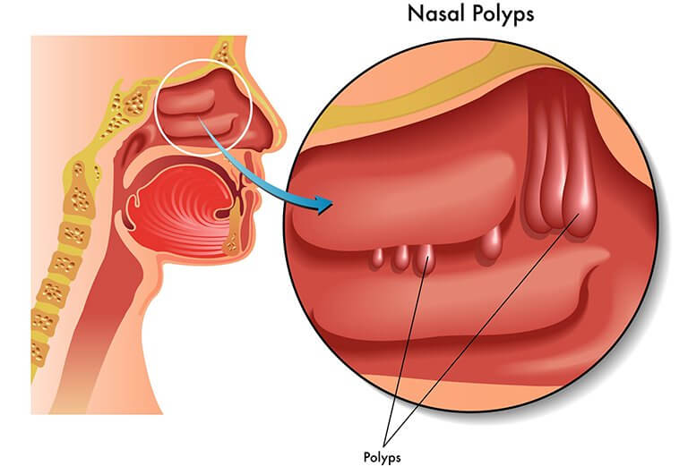 Dấu hiệu nhận biết Polyp mũi? Nguyên nhân và phương pháp chữa trị