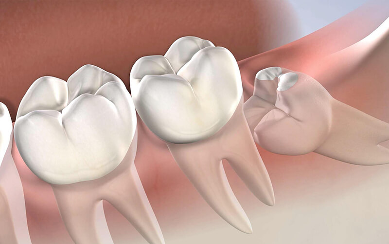 Răng khôn mọc lệch: Nguyên nhân & Cách điều trị