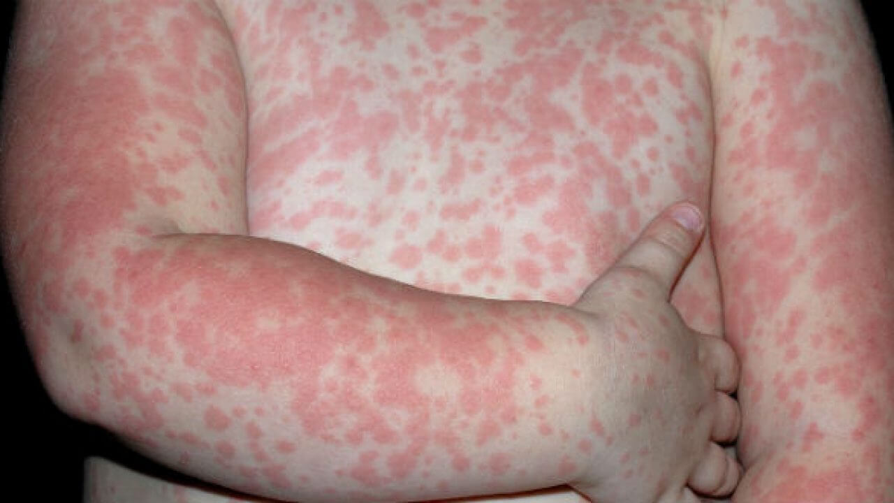 Sốt siêu vi có lây không? Nguyên nhân, triệu chứng và cách chữa trị