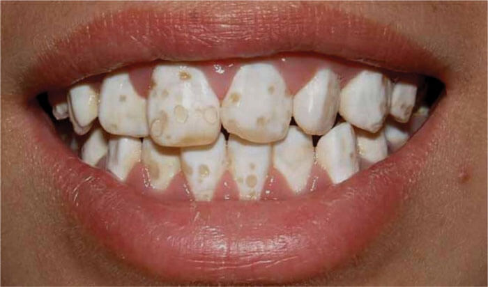 Bệnh thiếu sản men răng