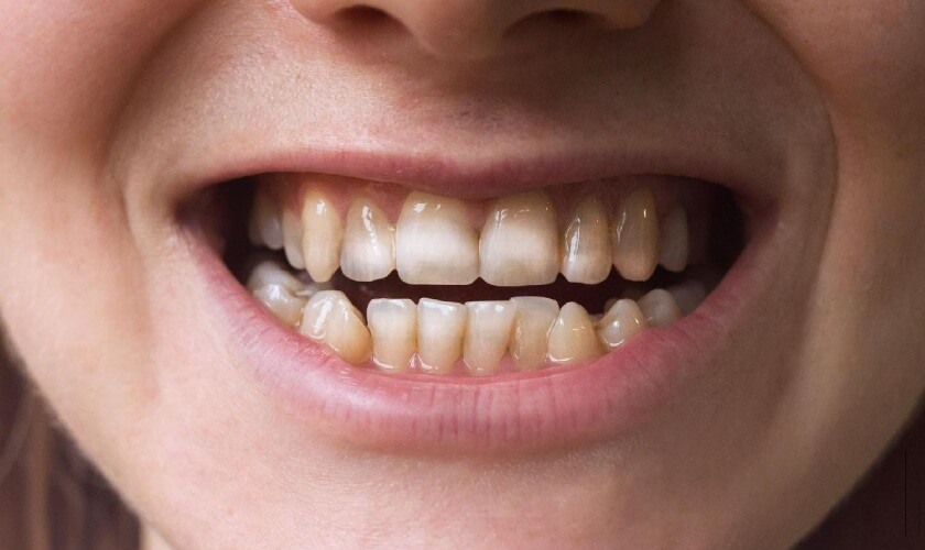 Thiếu sản men răng: Nguyên nhân, triệu chứng và cách chữa trị hiệu quả