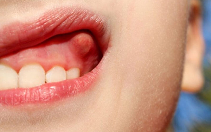 Tổng quan Viêm chân răng có mủ: Nguyên nhân, Triệu chứng & Phương pháp chữa trị