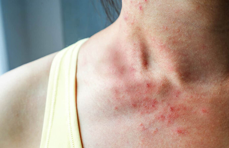 Bệnh viêm da tiếp xúc