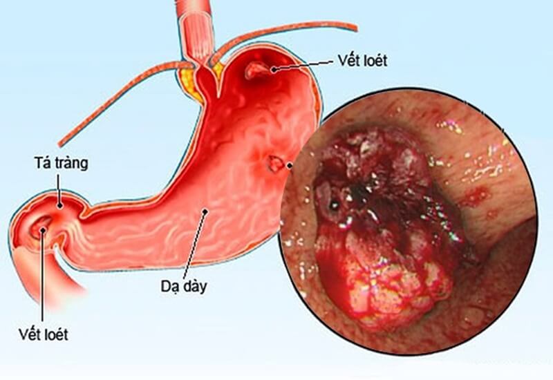 Viêm loét dạ dày: Nguyên nhân do đâu? Cách phòng ngừa và chữa trị hiệu quả
