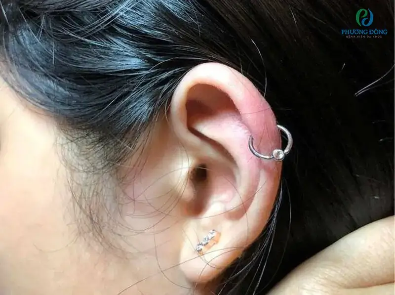 Viêm sụn vành tai có nguy hiểm không? Nguyên nhân, triệu chứng và cách chữa trị