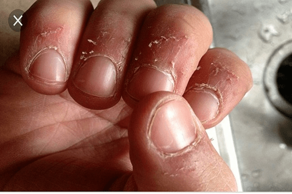 Bệnh xước măng tô