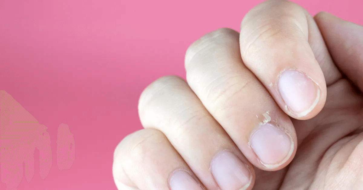 Xước măng rô: Nguyên nhân do đâu? Cách phòng ngừa và chữa trị hiệu quả