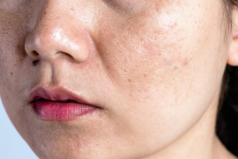 Bệnh nám do nội tiết tố