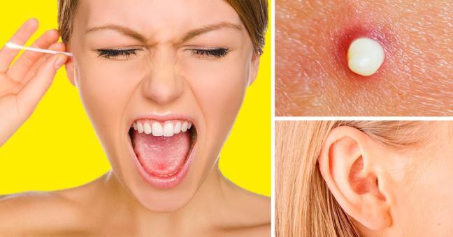 Mụn trong tai: Nguyên nhân & Cách điều trị