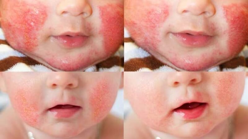 chữa trị chàm sữa