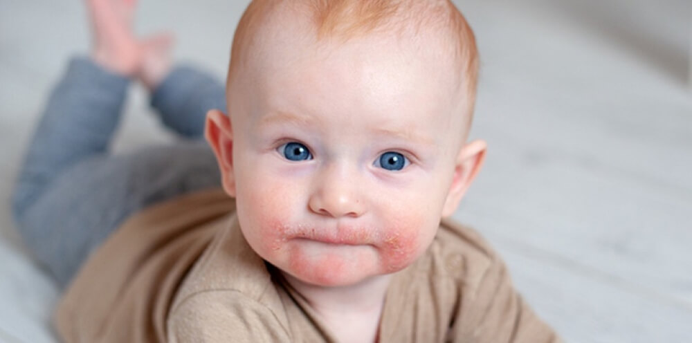 Mách mẹ cách chữa trị chàm sữa an toàn hiệu quả cho bé tại nhà