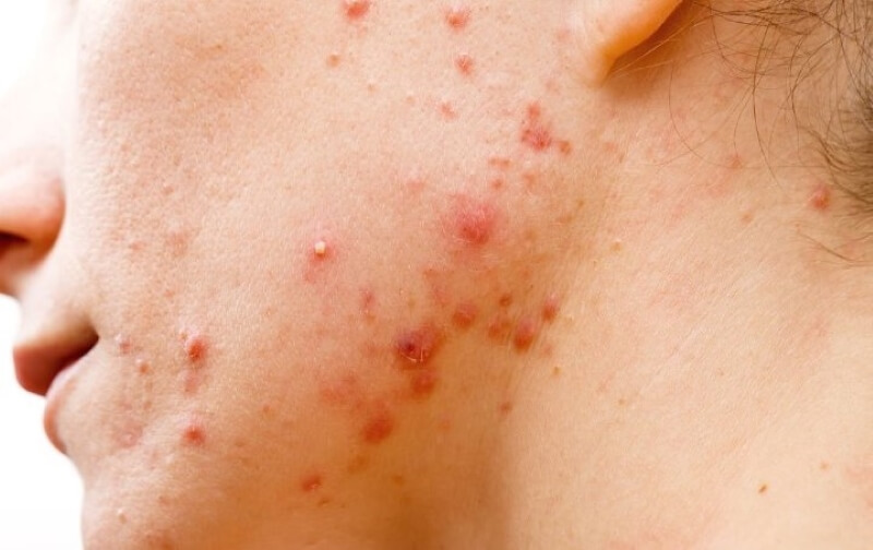 Dấu hiệu da nhiễm corticoid và cách chữa trị hiệu quả
