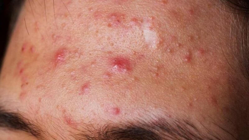 dị ứng mỹ phẩm