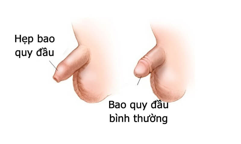 hẹp bao quy đầu