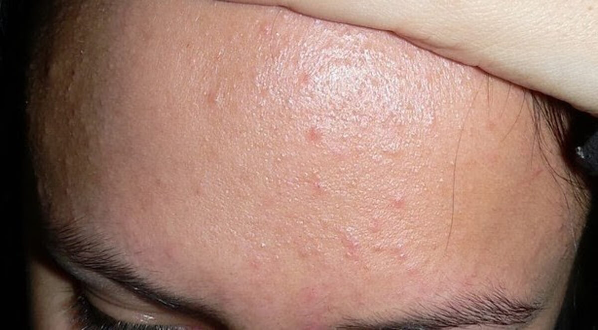 Da bị mụn ẩn
