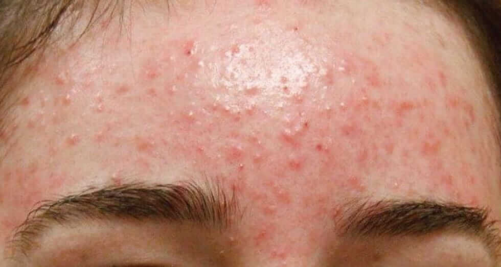Chữa trị mụn ẩn tại nhà an toàn và hiệu quả