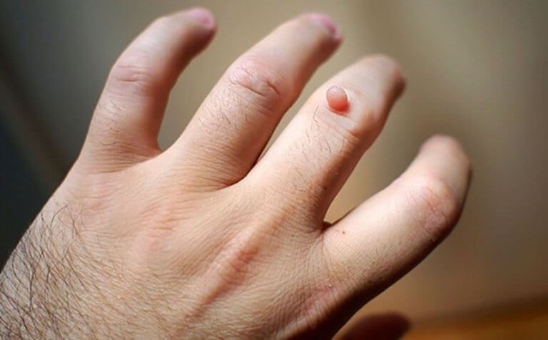 Mụn cóc là gì? Nguyên nhân, triệu chứng và cách chữa trị