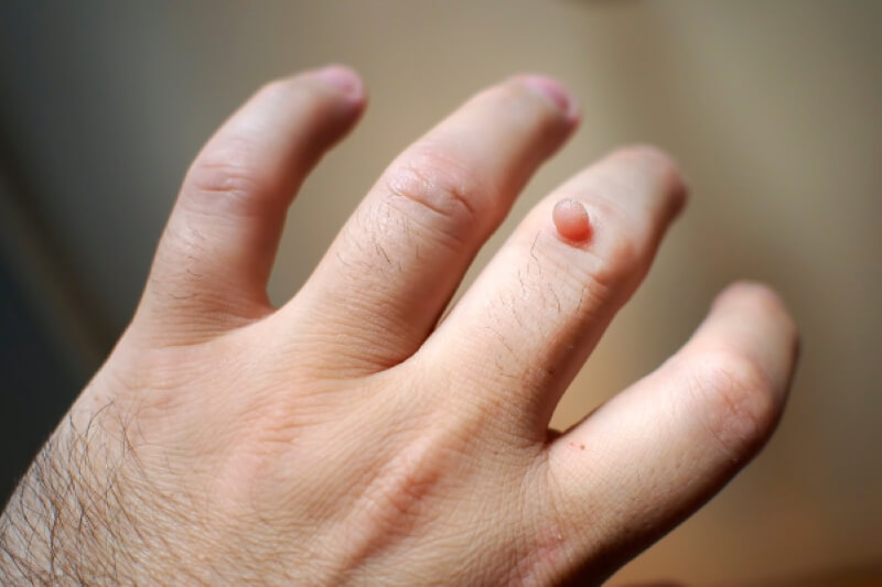Mụn cơm là gì? Các cách chữa trị mụn cơm tại nhà đơn giản mà hiệu quả