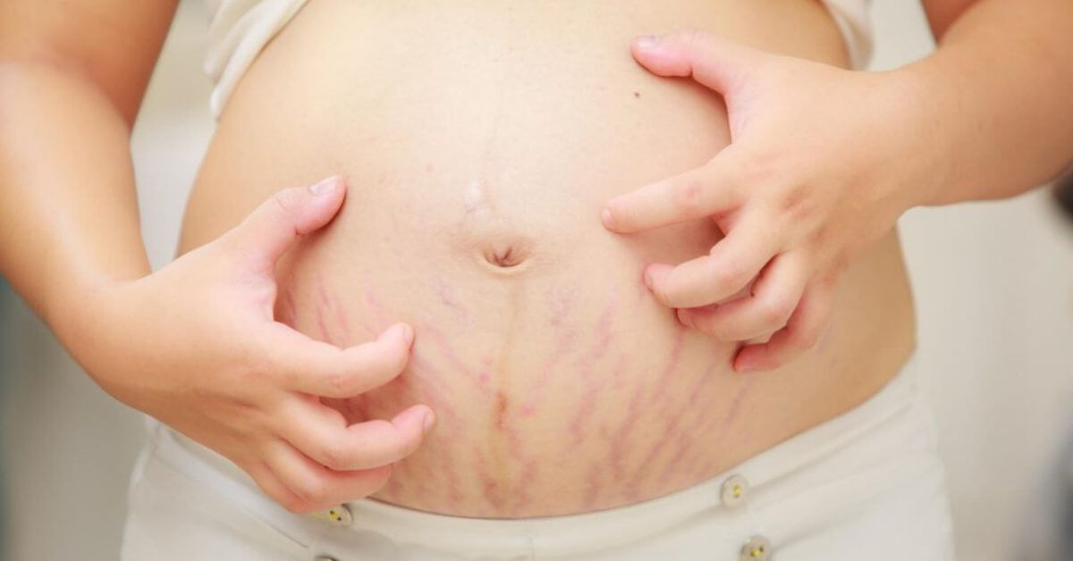 Nguyên nhân và cách chữa trị rạn da, làm mờ thâm hiệu quả