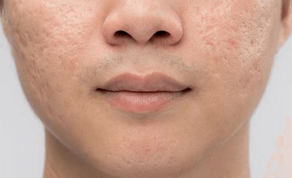 Sẹo rỗ: Nguyên nhân và cách phục hồi làn da sau mụn