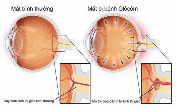 chữa trị thiên đầu thống