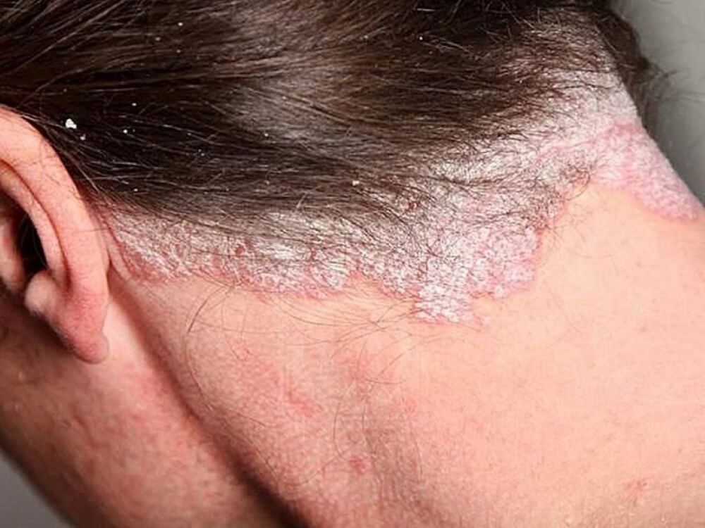 Vảy nến da đầu: Nguyên nhân, dấu hiệu và cách chữa trị