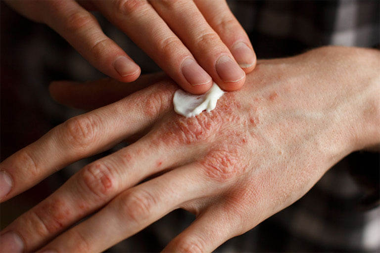 Bệnh viêm da tiếp xúc