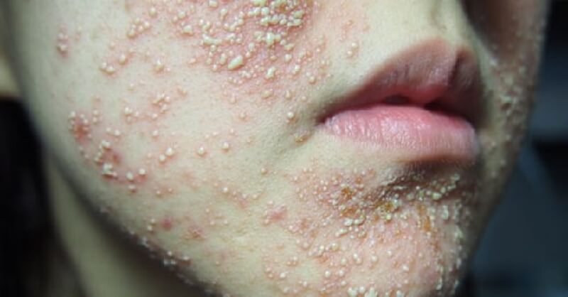da nhiễm corticoid