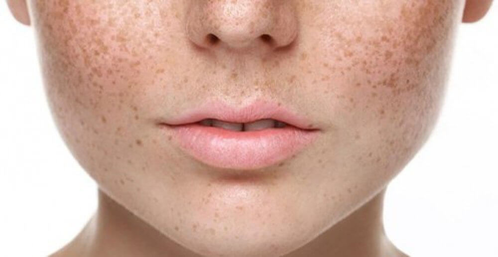 Nám: Nguyên nhân do đâu? Cách phòng ngừa và chữa trị hiệu quả