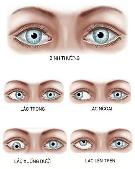 các loại mắt lác