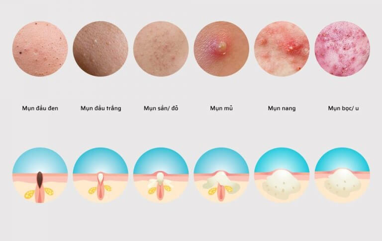 Các loại mụn thường gặp