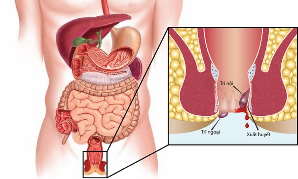 Trĩ nội: Nguyên nhân do đâu? Cách phòng ngừa và chữa trị hiệu quả