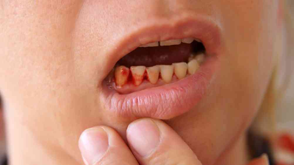 Chảy máu chân răng: Nguyên nhân do đâu? Cách phòng ngừa và chữa trị hiệu quả