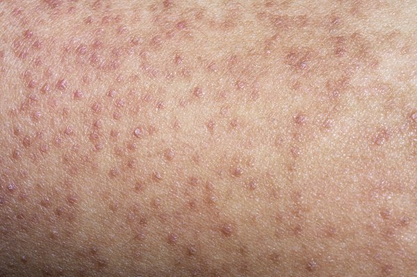 chữa trị dày sừng nang lông