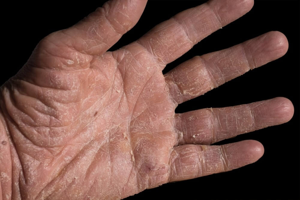 Dày sừng lòng bàn tay là gì? Dấu hiệu nhận biết và cách chữa trị