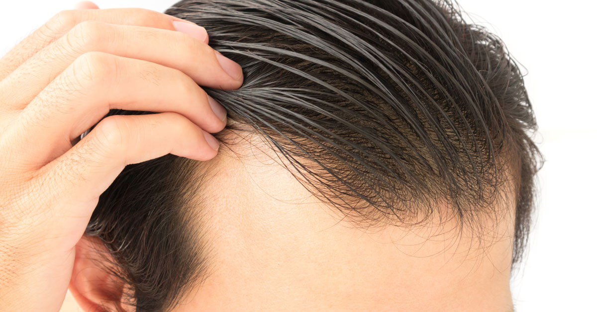 chữa trị hói đầu